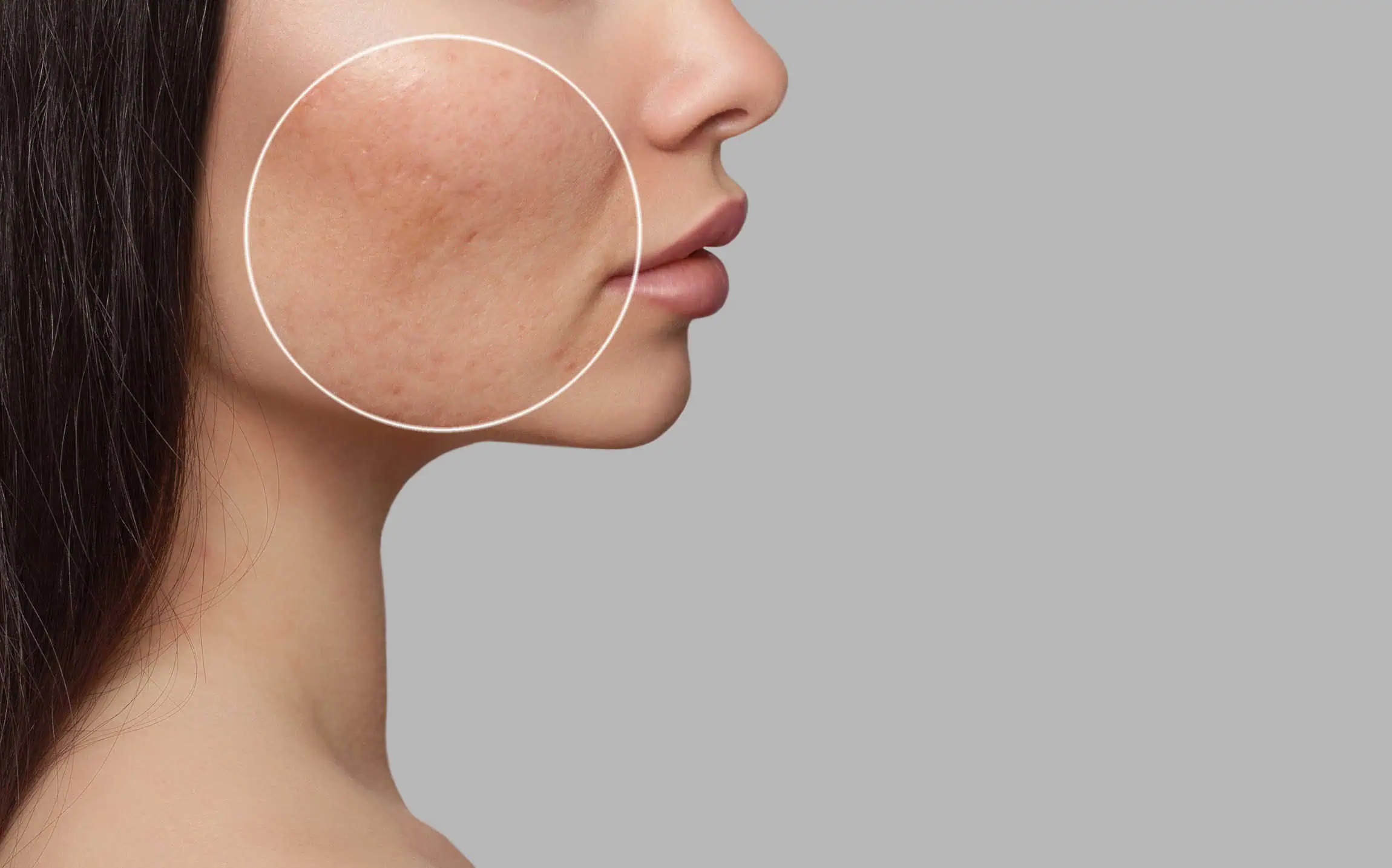 Acne-Scars-in-Idaho-Falls-ID | Evara aesthetics