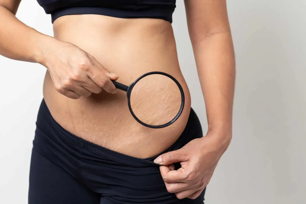 Stretch-Marks-After-Pregnancy-blog-in-idaho-falls-id | Evara aesthetics