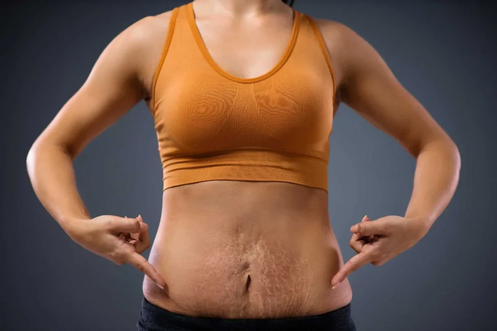 Stretch-Marks-blog-in-idaho-falls-id | Evara aesthetics