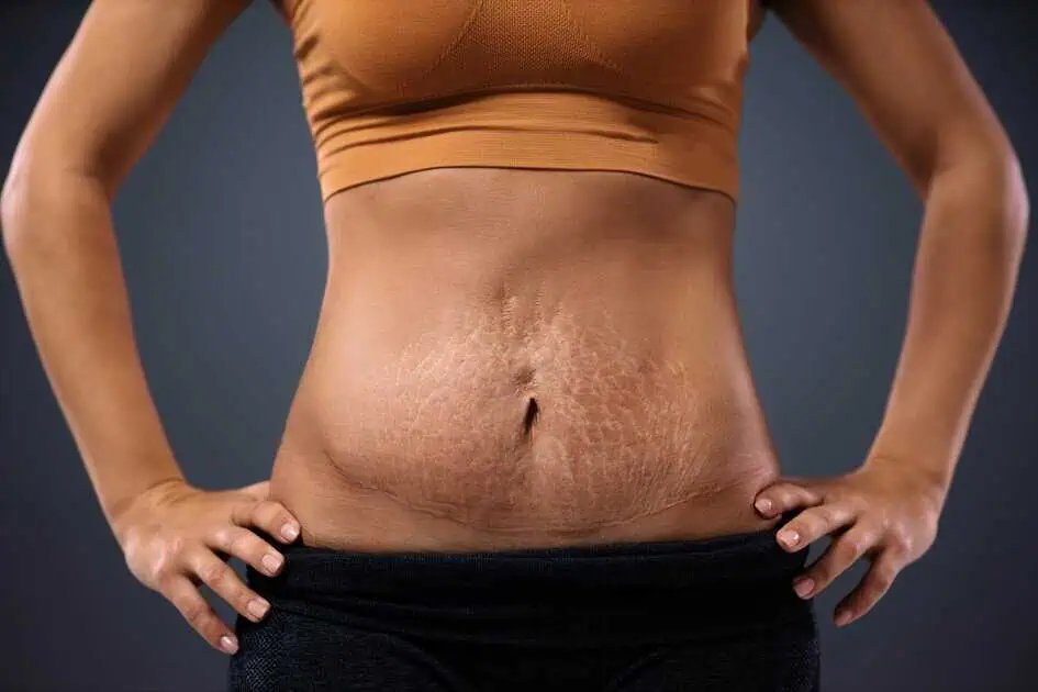 Stretch Marks Treatments In Idaho Falls, ID by Bella Jade Medspa, PLLC